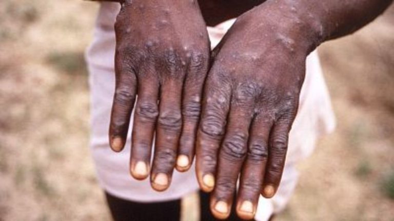 Ampollas viruela del mono